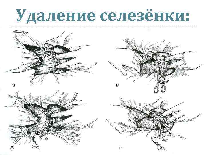 Спленэктомия это