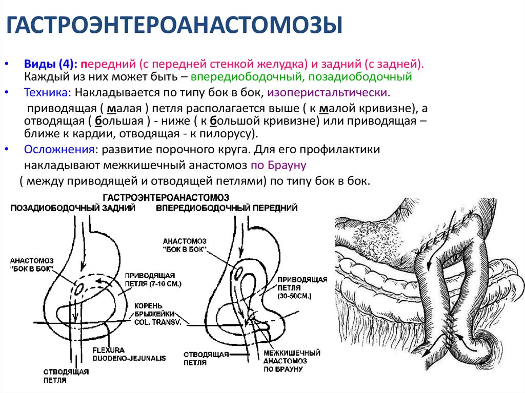 Анастомоз по брауну схема