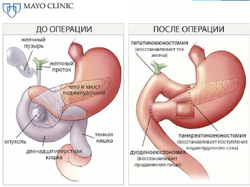 операция обходного желудочного анастомоза и операция Уиппла