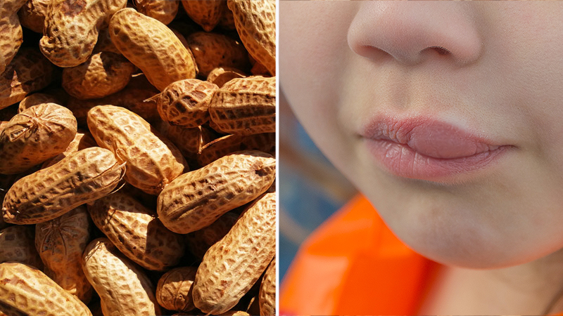 Аллергия на арахис" или "Опасность соленого арахиса для людей с аллергией